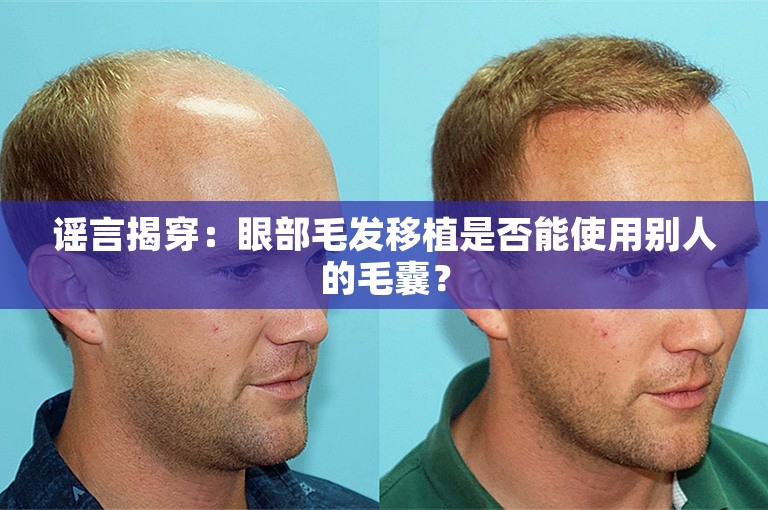 谣言揭穿：眼部毛发移植是否能使用别人的毛囊？