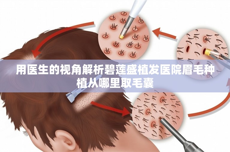 用医生的视角解析碧莲盛植发医院眉毛种植从哪里取毛囊