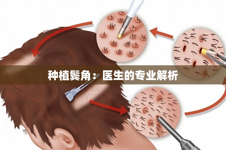  种植鬓角：医生的专业解析 