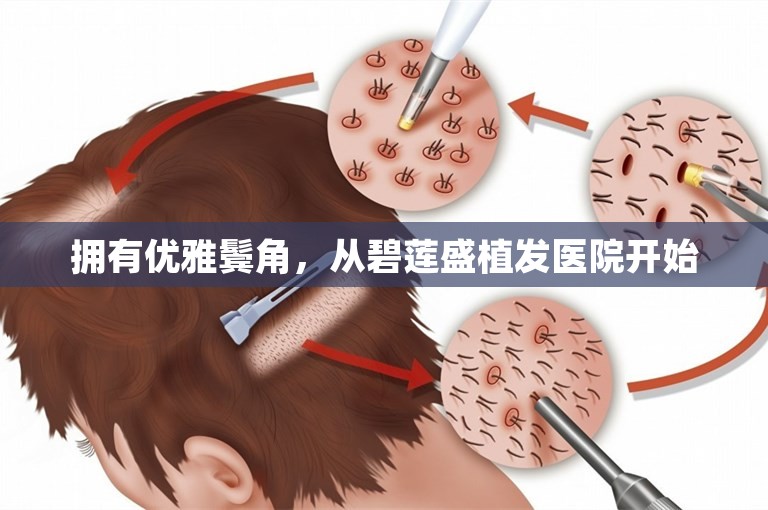 拥有优雅鬓角，从碧莲盛植发医院开始