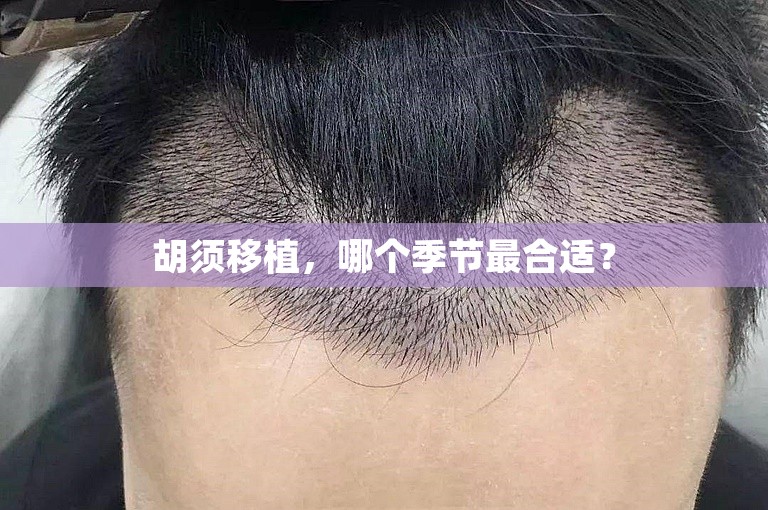 胡须移植，哪个季节最合适？