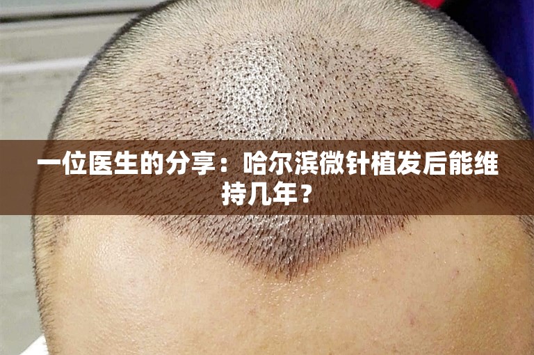 一位医生的分享：哈尔滨微针植发后能维持几年？