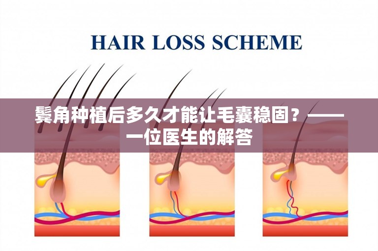 鬓角种植后多久才能让毛囊稳固？——一位医生的解答