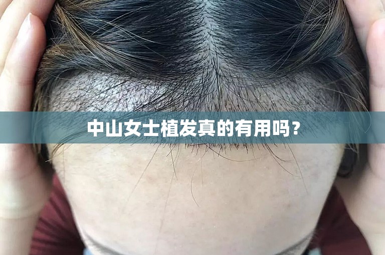 中山女士植发真的有用吗？