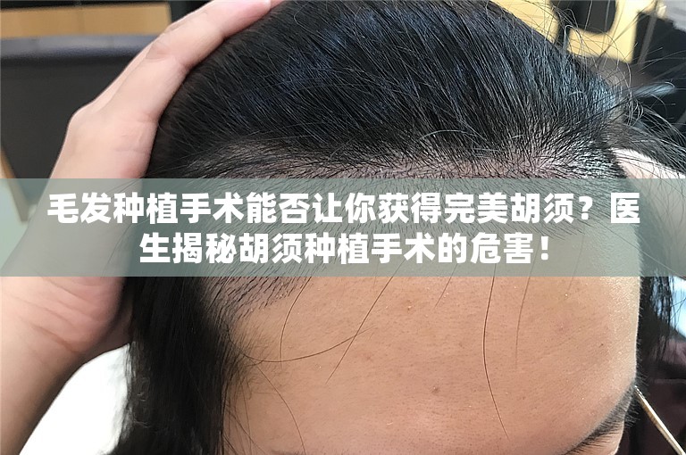 毛发种植手术能否让你获得完美胡须？医生揭秘胡须种植手术的危害！