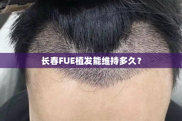 长春FUE植发能维持多久？