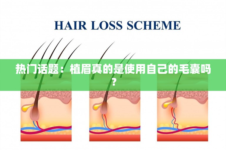 热门话题：植眉真的是使用自己的毛囊吗？