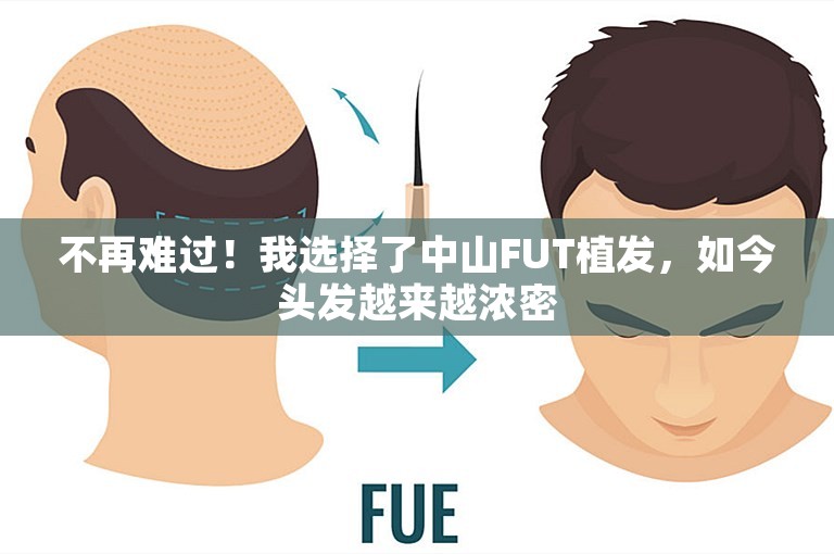 不再难过！我选择了中山FUT植发，如今头发越来越浓密