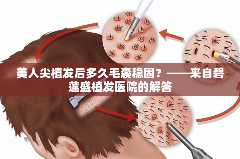 美人尖植发后多久毛囊稳固？——来自碧莲盛植发医院的解答