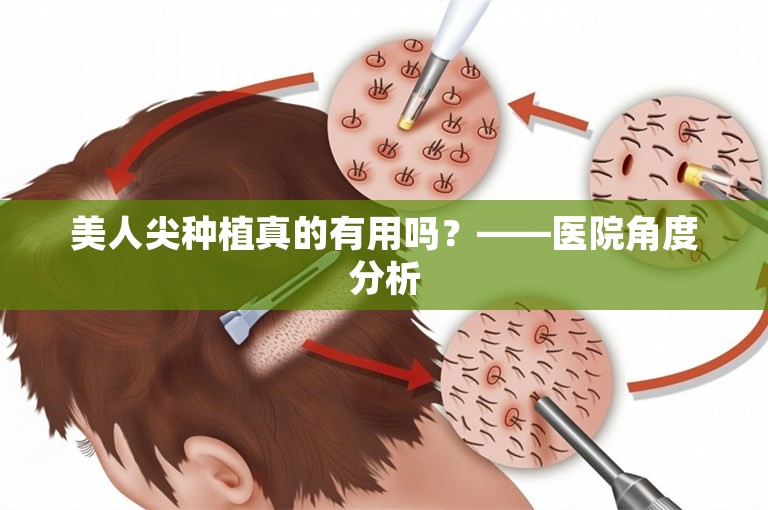 美人尖种植真的有用吗？——医院角度分析