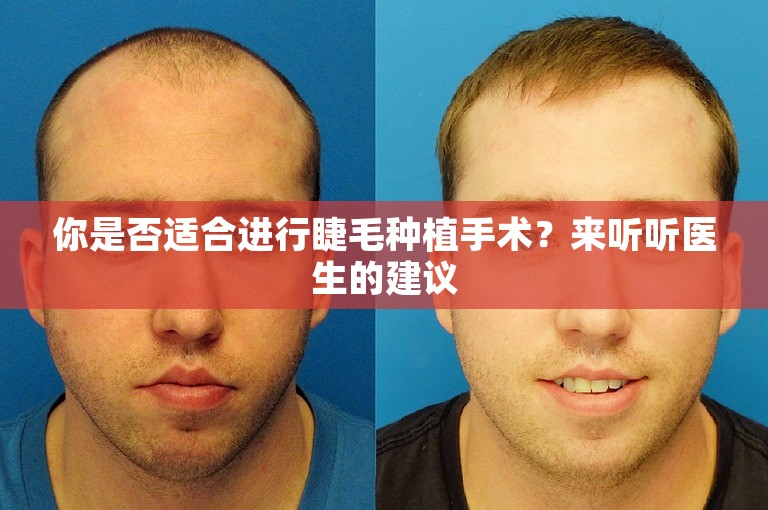 你是否适合进行睫毛种植手术？来听听医生的建议