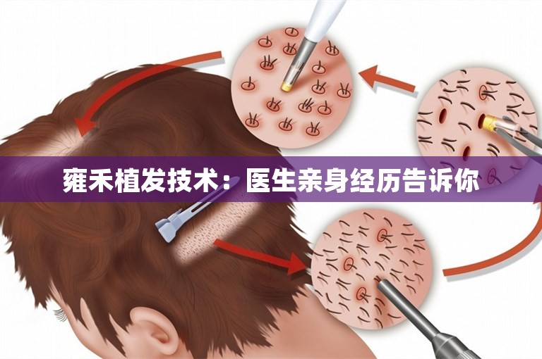 雍禾植发技术：医生亲身经历告诉你