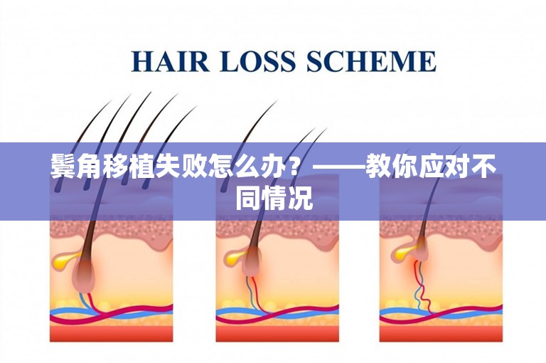 鬓角移植失败怎么办？——教你应对不同情况