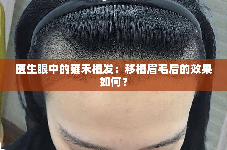 医生眼中的雍禾植发：移植眉毛后的效果如何？