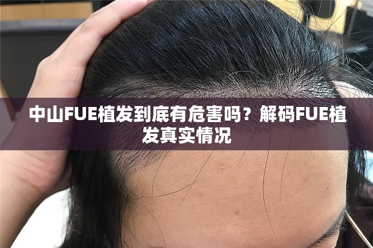 中山FUE植发到底有危害吗？解码FUE植发真实情况