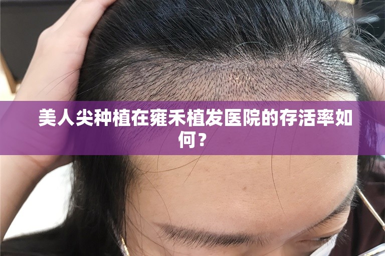  美人尖种植在雍禾植发医院的存活率如何？