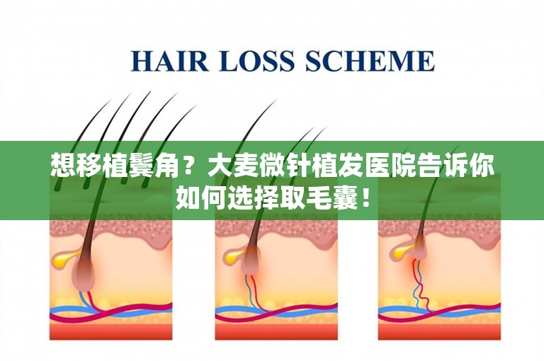 想移植鬓角？大麦微针植发医院告诉你如何选择取毛囊！