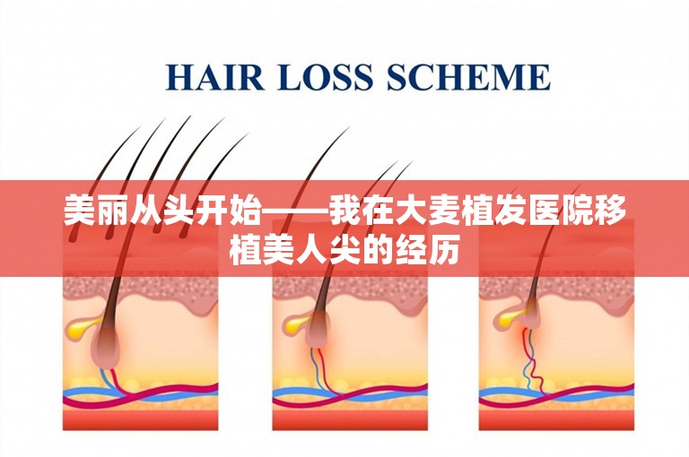 美丽从头开始——我在大麦植发医院移植美人尖的经历