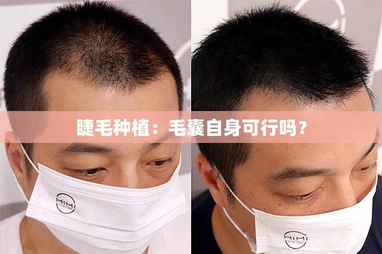 睫毛种植：毛囊自身可行吗？