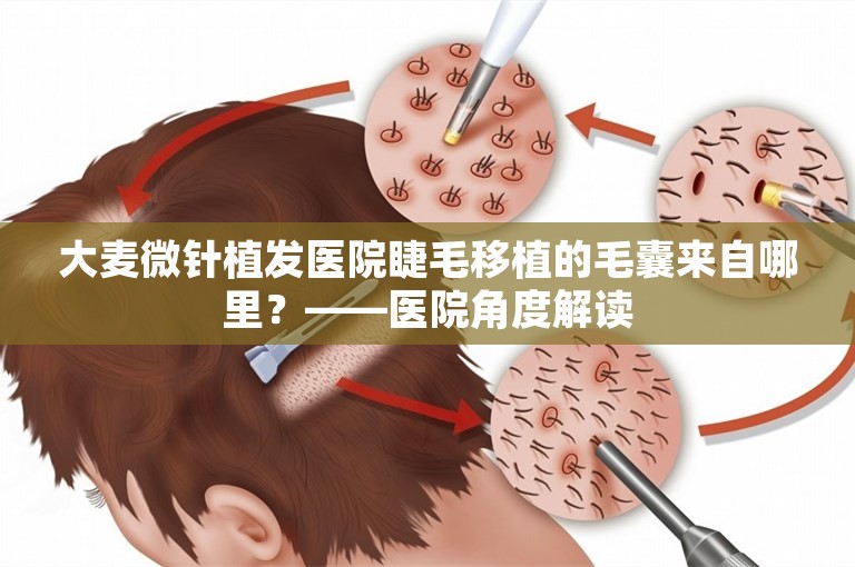 大麦微针植发医院睫毛移植的毛囊来自哪里？——医院角度解读