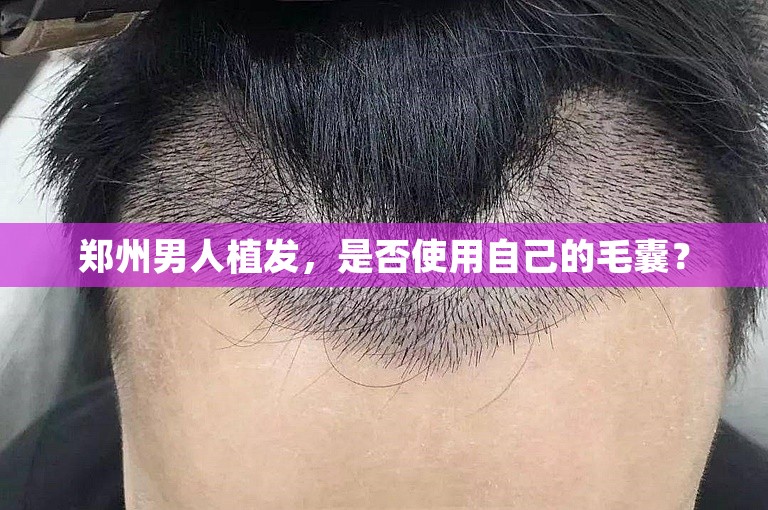 郑州男人植发，是否使用自己的毛囊？