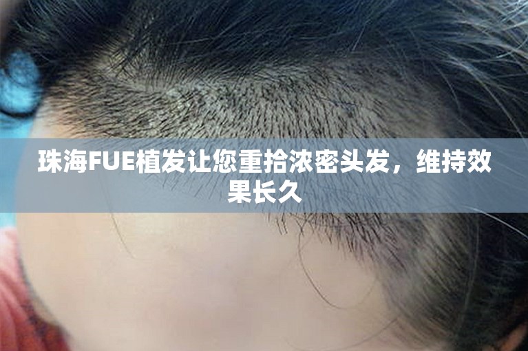 珠海FUE植发让您重拾浓密头发，维持效果长久