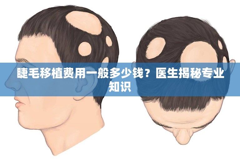 睫毛移植费用一般多少钱？医生揭秘专业知识