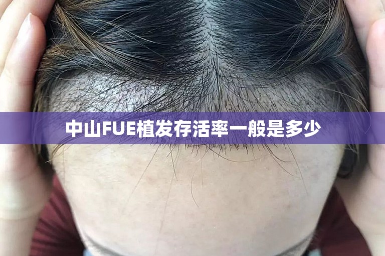 中山FUE植发存活率一般是多少