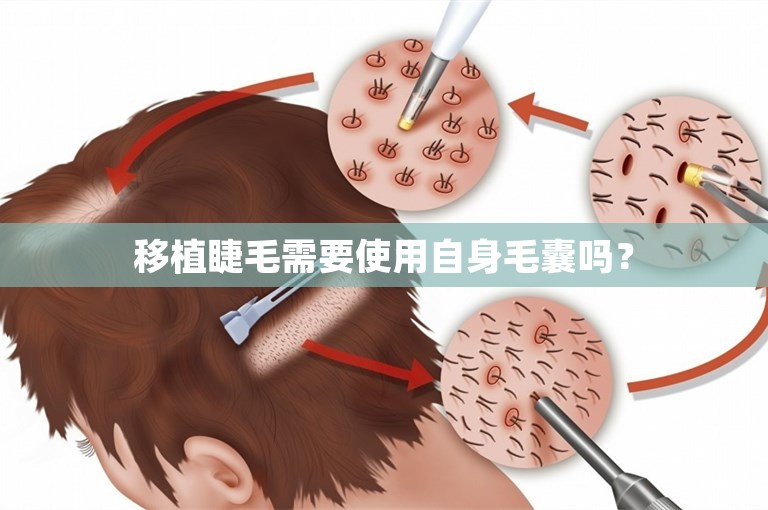 移植睫毛需要使用自身毛囊吗？