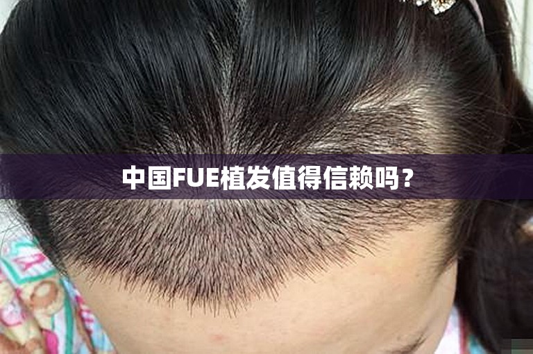 中国FUE植发值得信赖吗？