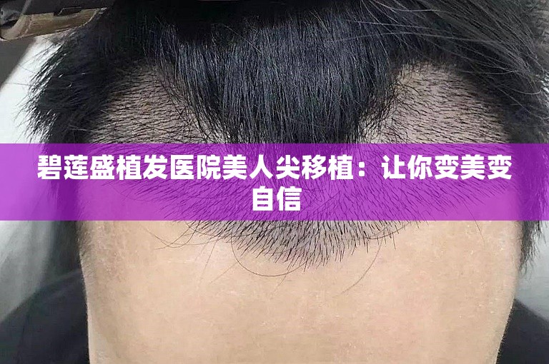 碧莲盛植发医院美人尖移植：让你变美变自信