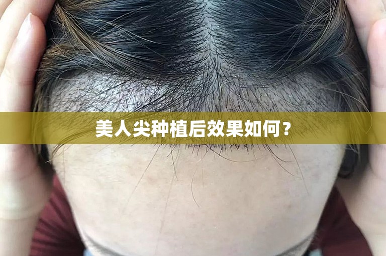 美人尖种植后效果如何？