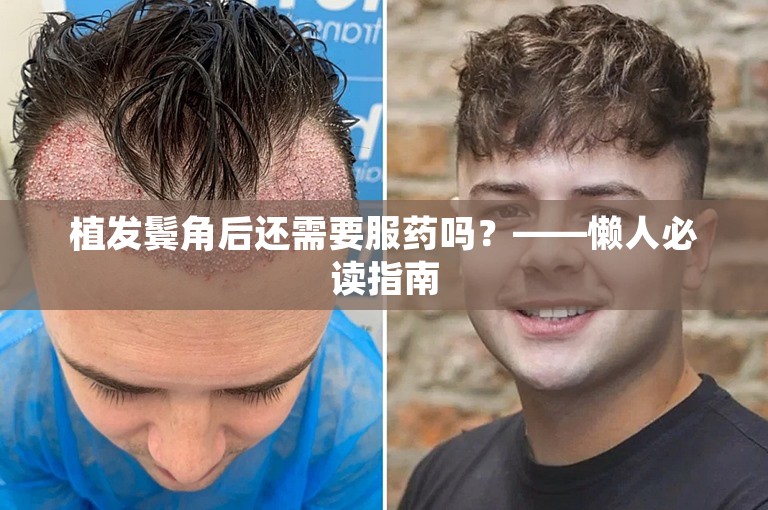 植发鬓角后还需要服药吗？——懒人必读指南