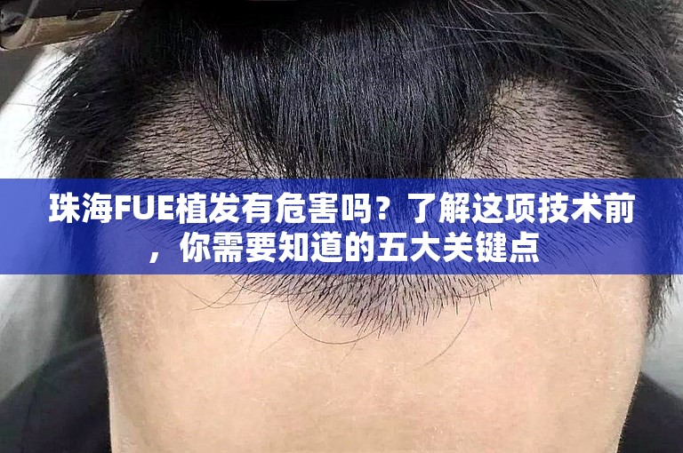 珠海FUE植发有危害吗？了解这项技术前，你需要知道的五大关键点