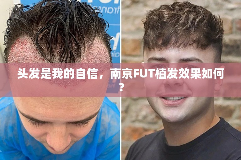 头发是我的自信，南京FUT植发效果如何？