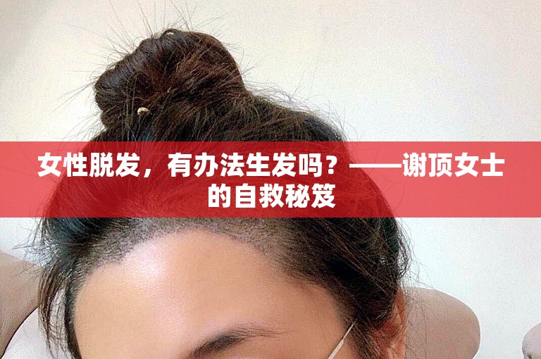 女性脱发，有办法生发吗？——谢顶女士的自救秘笈