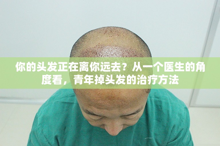 你的头发正在离你远去？从一个医生的角度看，青年掉头发的治疗方法