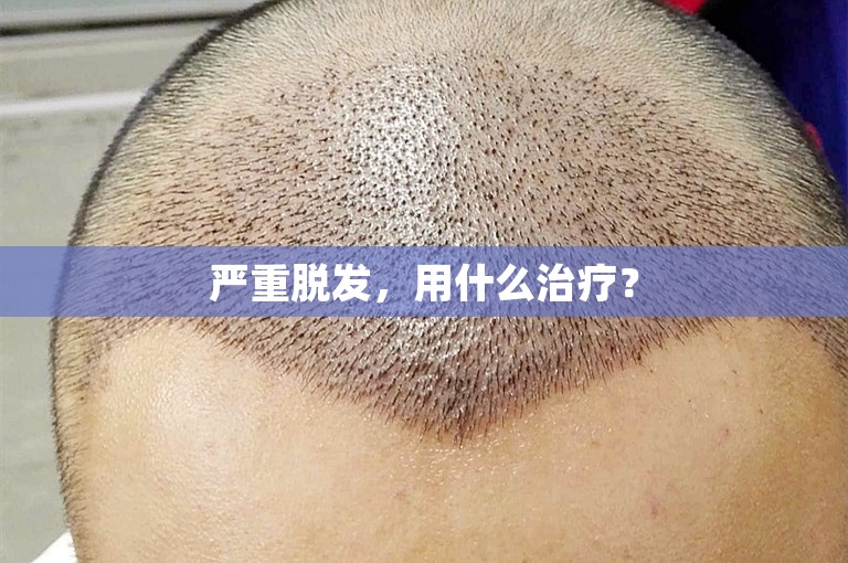 严重脱发，用什么治疗？