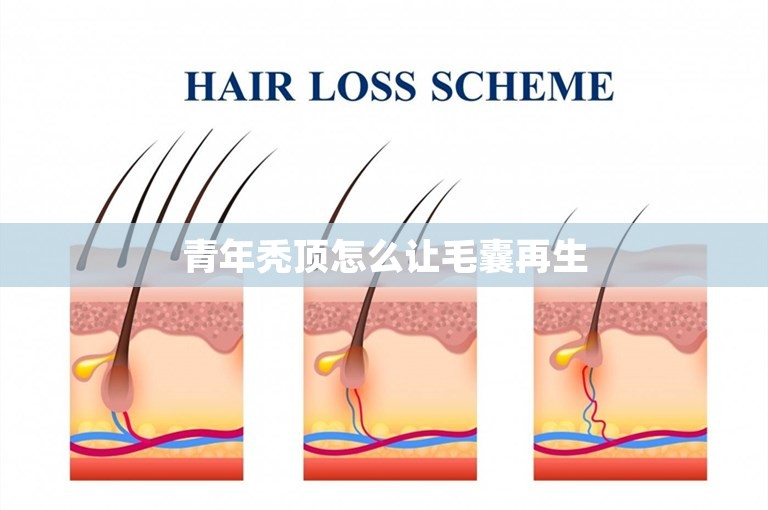 青年秃顶怎么让毛囊再生