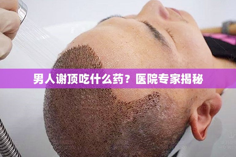 男人谢顶吃什么药？医院专家揭秘