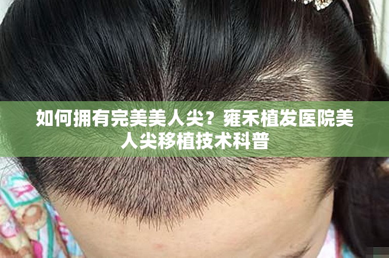 如何拥有完美美人尖？雍禾植发医院美人尖移植技术科普