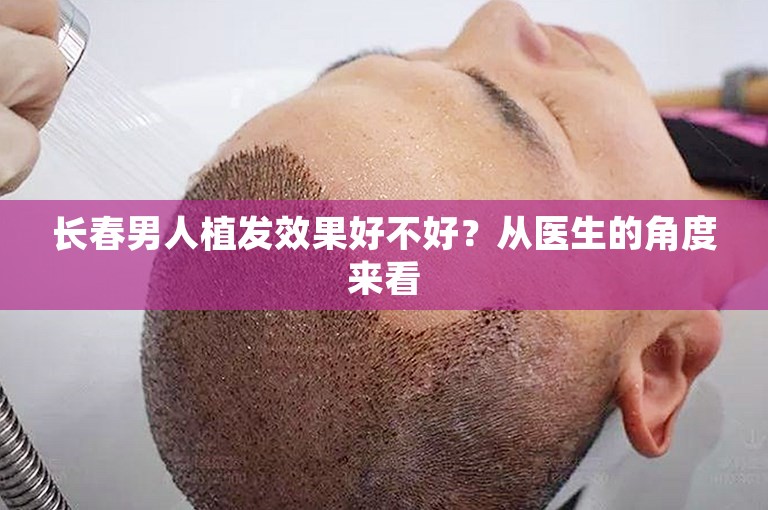 长春男人植发效果好不好？从医生的角度来看