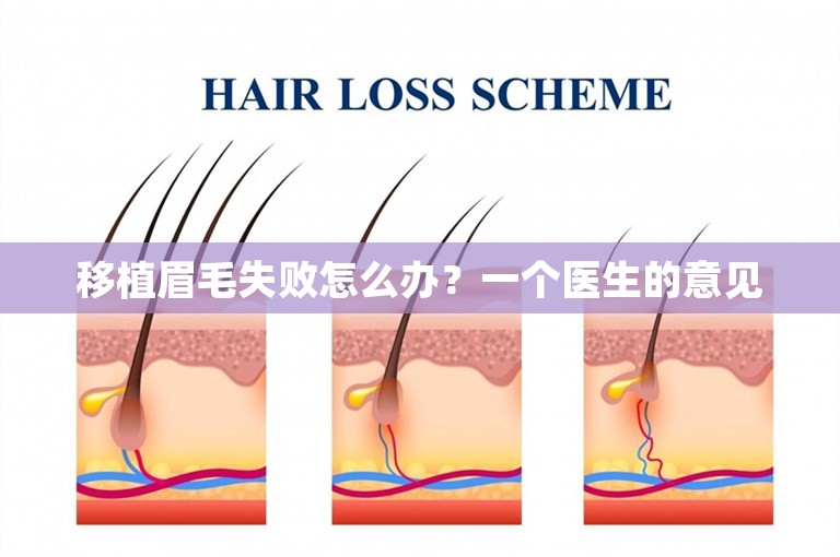 移植眉毛失败怎么办？一个医生的意见