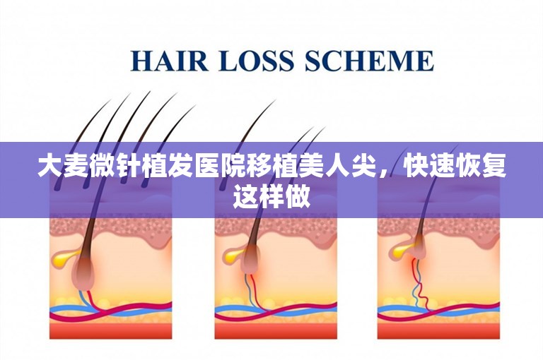 大麦微针植发医院移植美人尖，快速恢复这样做