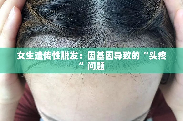 女生遗传性脱发：因基因导致的“头疼”问题