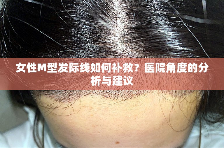 女性M型发际线如何补救？医院角度的分析与建议