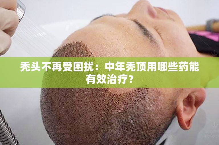 秃头不再受困扰：中年秃顶用哪些药能有效治疗？