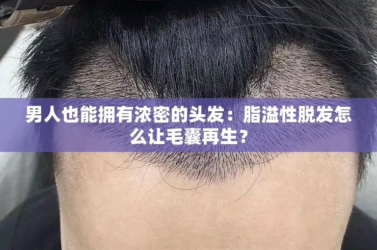 男人也能拥有浓密的头发：脂溢性脱发怎么让毛囊再生？