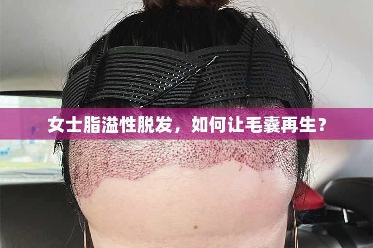 女士脂溢性脱发，如何让毛囊再生？