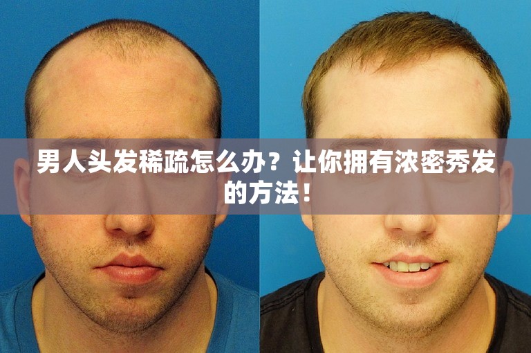 男人头发稀疏怎么办？让你拥有浓密秀发的方法！